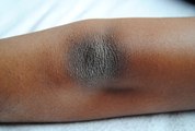 How to Get Rid of Black Knees and Dark Elbows