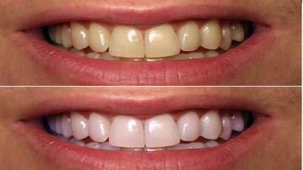 How to Whiten Teeth at Home in 5 Minutes