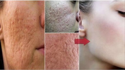 How to Remove Pores On Your Face At Home Using Only 1 Ingredient