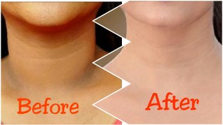 How to Get Rid of Black Neck in 2 Days