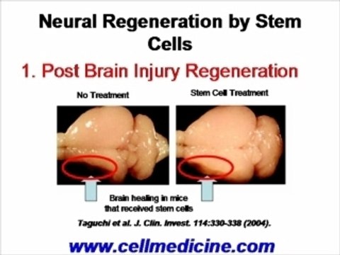 Stem Cell Therapy for Multiple Sclerosis