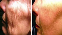 This woman has managed to eliminate wrinkles within hours with this recipe.