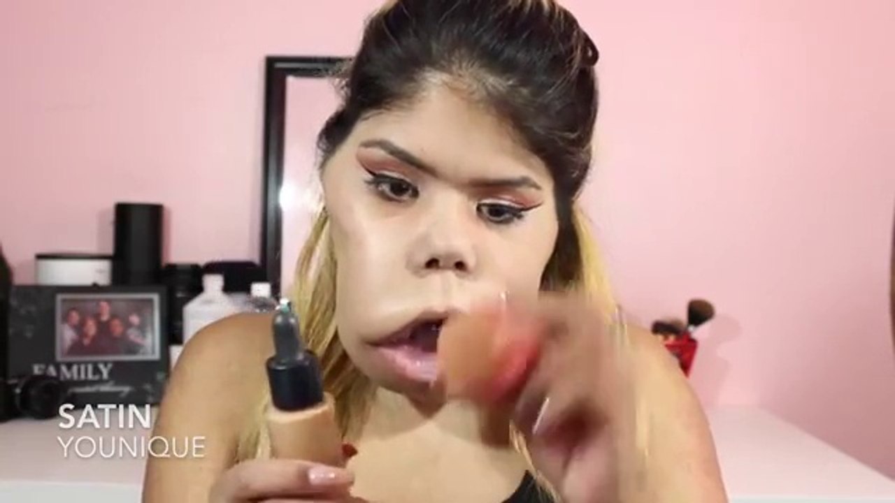 Cette fille est atteinte d'une terrible tumeur faciale qui lui déforme le visage