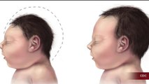 Zika Babies Born With Abnormally Small Heads: Report