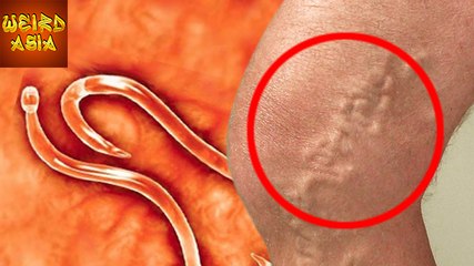 Patient REMOVES WORM From His Foot | Weird Asia