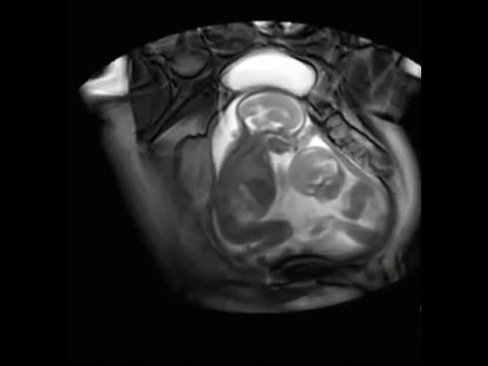 Doi bebeluși au fost surprinși în burtica mamei lor în timp ce se jucau. Este cel mai frumos lucru pe care l-am văzut!