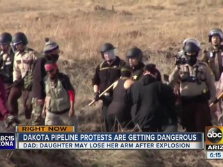 A Dakota Access pipeline protester could lose an arm
