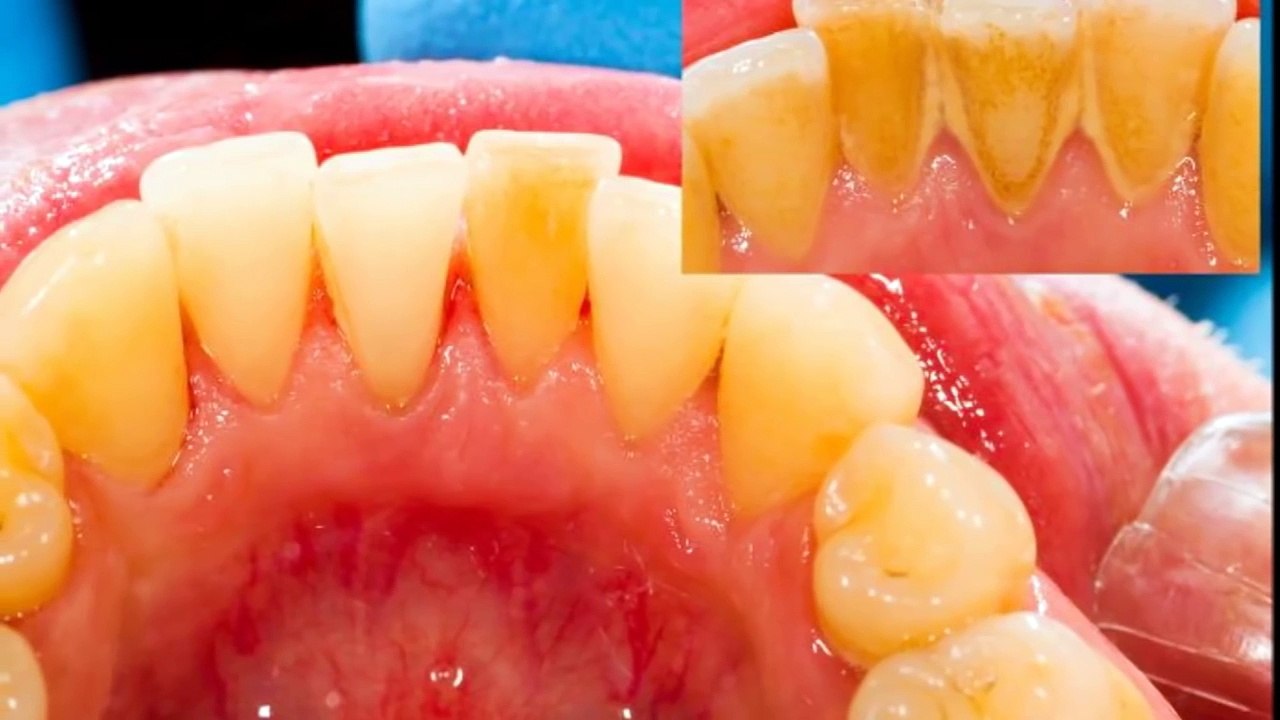How To Remove Teeth Tartar & Plaque In 5 Minutes | Health Tips