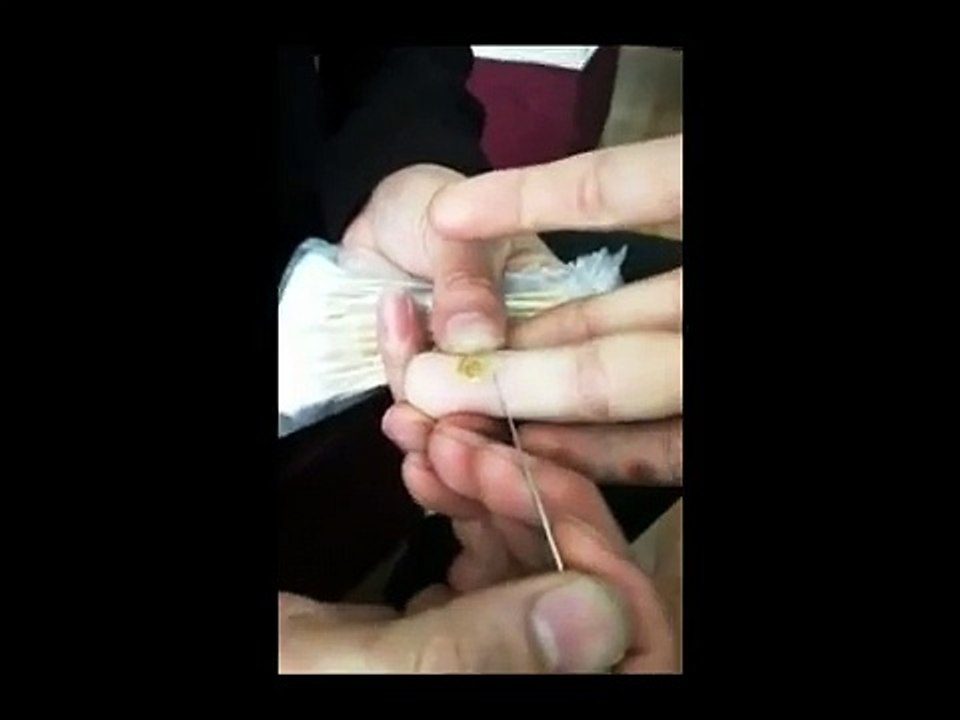 Professional Hand Care (2) Removal of Hard Skin and Treatment of Verruca Vulgaris (Common Warts)