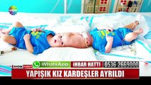 Yapışık ikizler ayrıldı