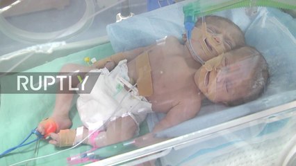 Ce bébé à deux têtes est né cette semaine à Gaza