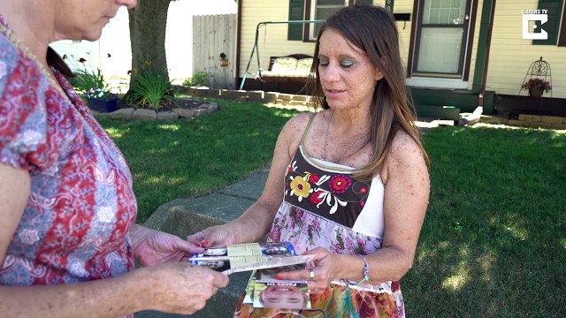 Une femme vit avec 5500 tumeurs sur le corps