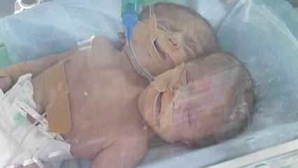 Un bébé à deux têtes né à Gaza en Palestine