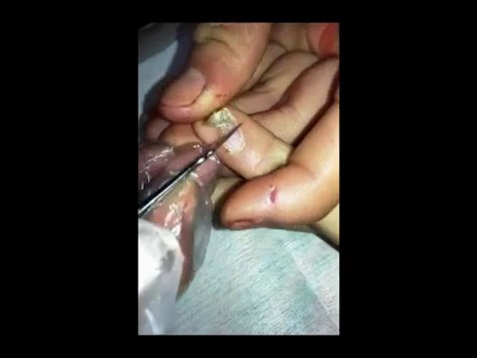 Professional Hand Care (5) Removal of Hard Skin and Treatment of Verruca Vulgaris Common Warts