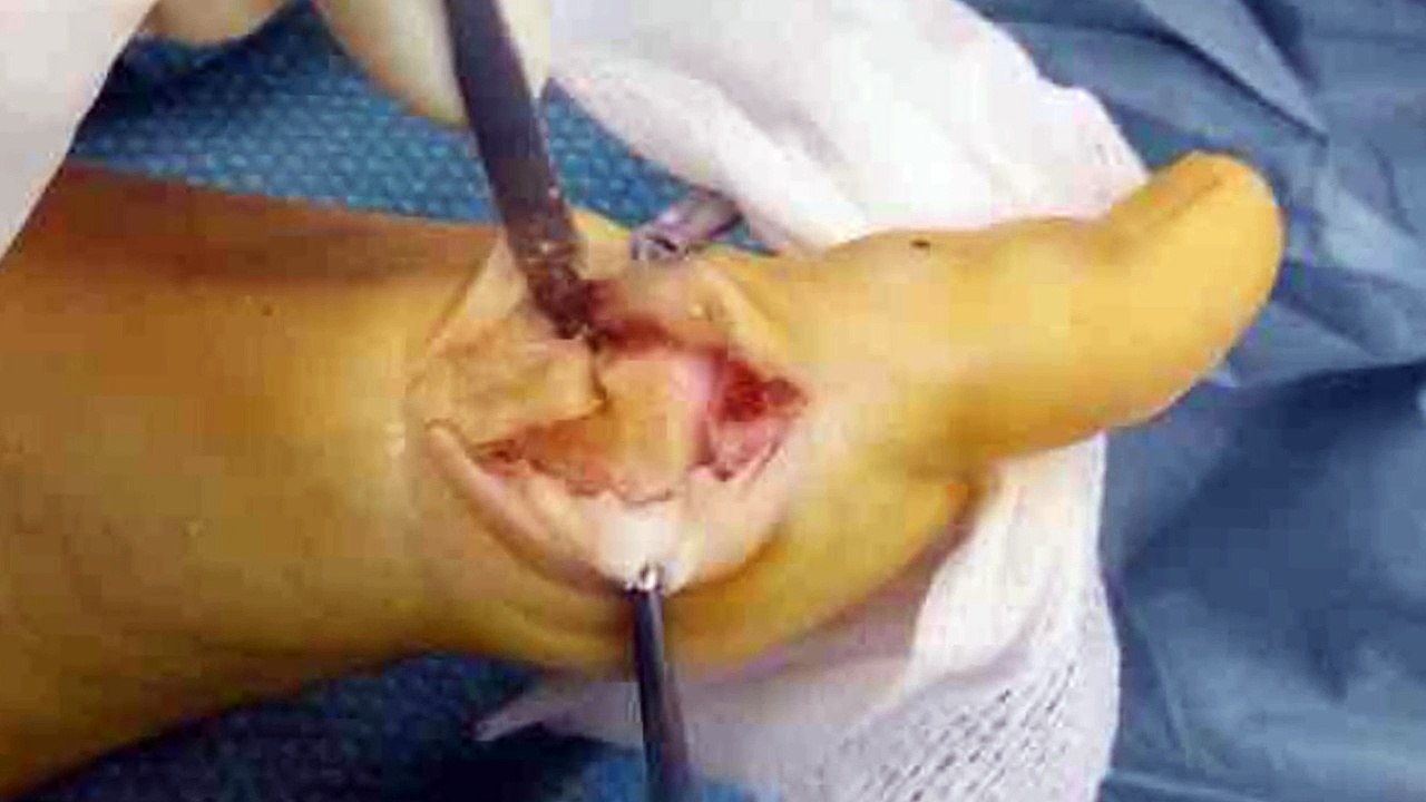 ¿Qué son los juanetes? Cómo tratarlos y curarlos