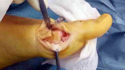 ¿Qué son los juanetes? Cómo tratarlos y curarlos