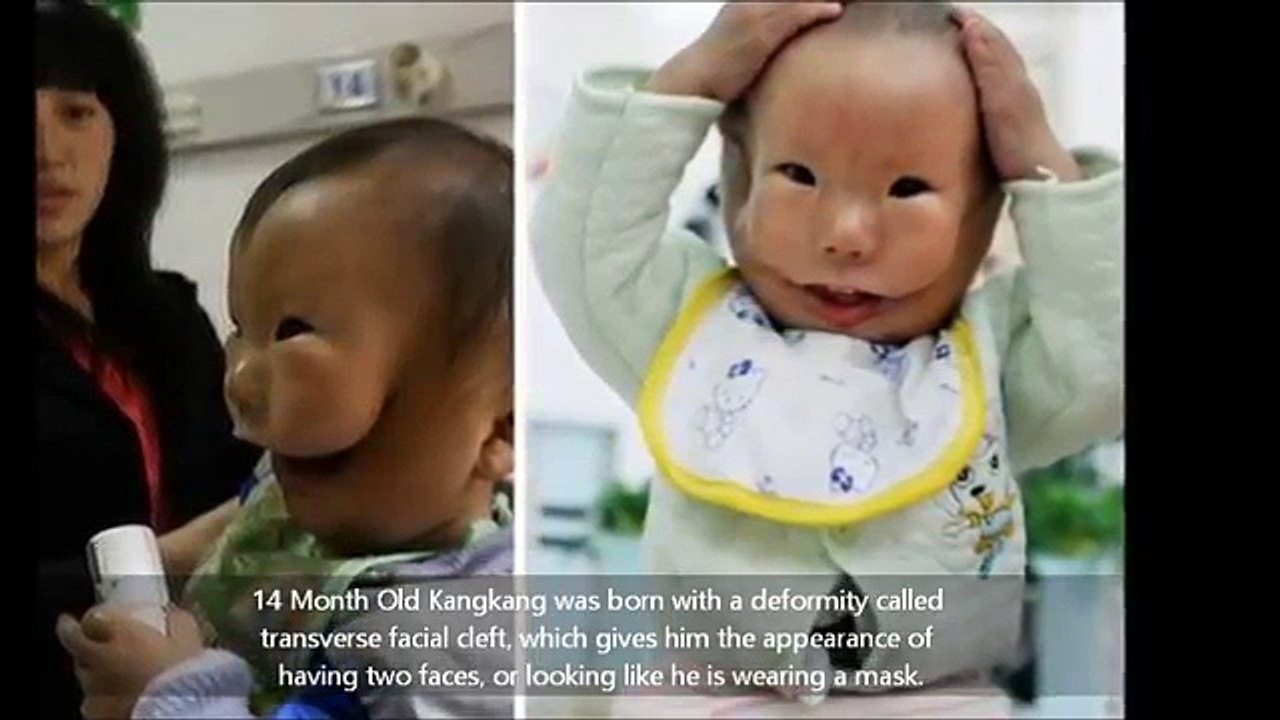 Un Bebe Atteint D Une Etrange Malformation Video Dailymotion