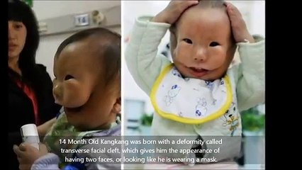 Ce bébé est atteint d'une malformation très étrange