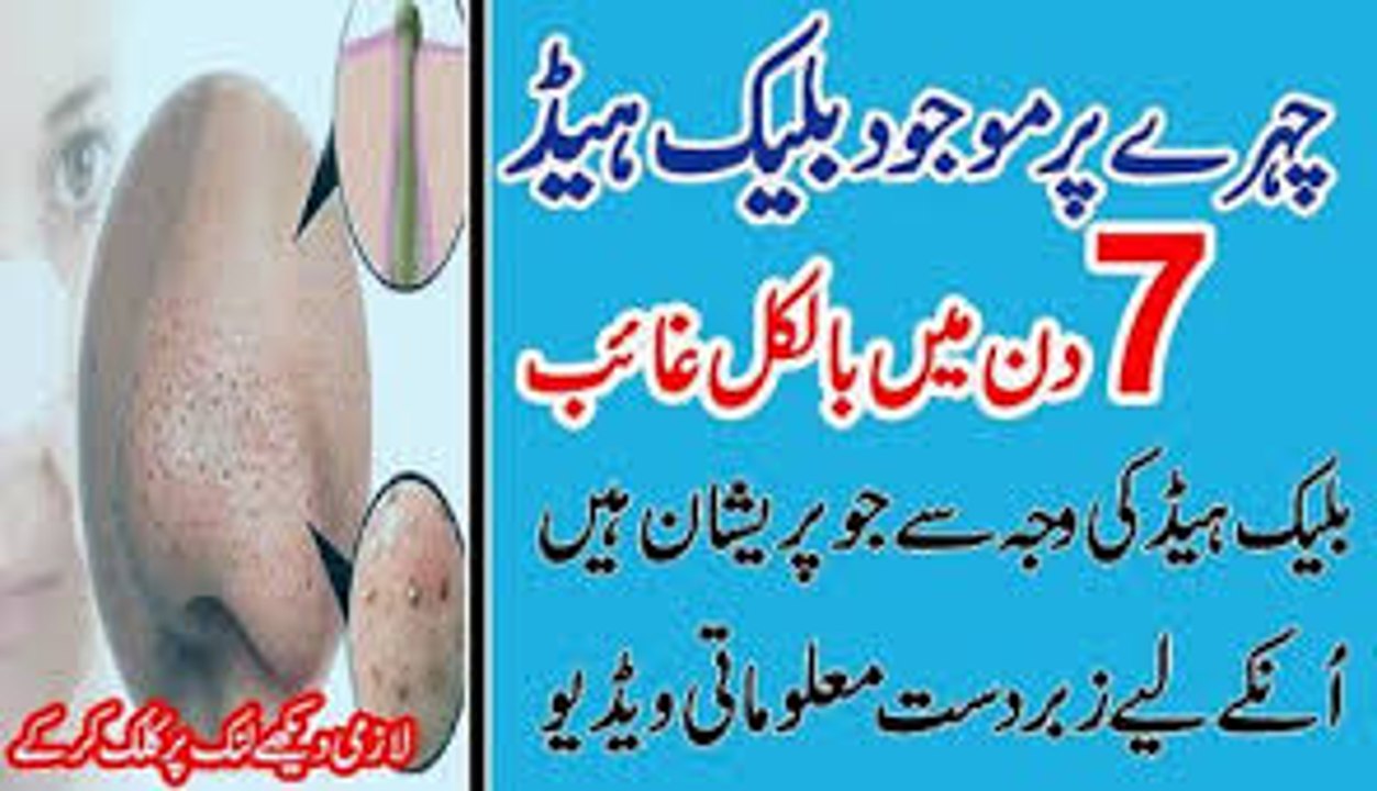 Blackhead Khatam Karne Ka Asan Gharelu Ilaj  How to Remove Blackheads From Nose & Face