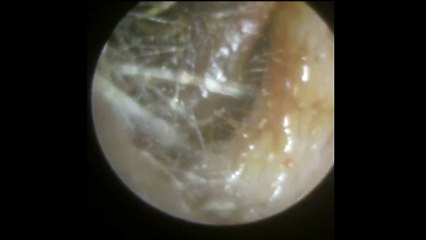 Where To Get Microsuction Earwax Removal Kensington