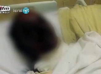 NDOYE~1 à la rencontre de Babacar Mbaye ébouillanté par sa femm