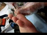 Professional Foot Care (23) Removal of Dirt and Treatment of Plantar Warts