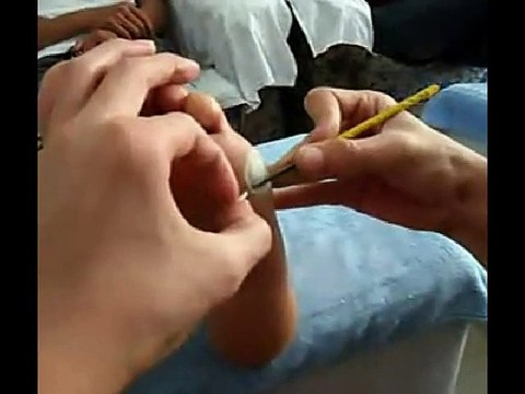 Professional Foot Care (25) Treatment of Foot Diseases and Nail Fungus