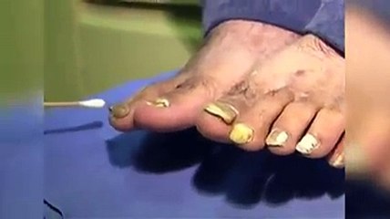 Onicomicosis ¿Qué es y cómo podemos identificarla?