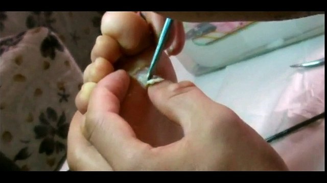 Professional Foot Care (37) Relaxing Treatment of Foot Diseases and Plantar Warts