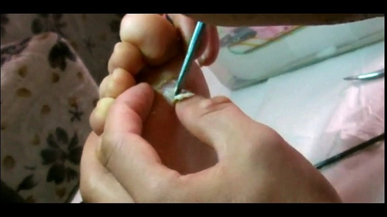 Professional Foot Care (37) Relaxing Treatment of Foot Diseases and Plantar Warts