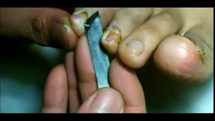 Professional Foot Care (41) Relaxing Nail Pedicure and Treatment of Nail Fungus