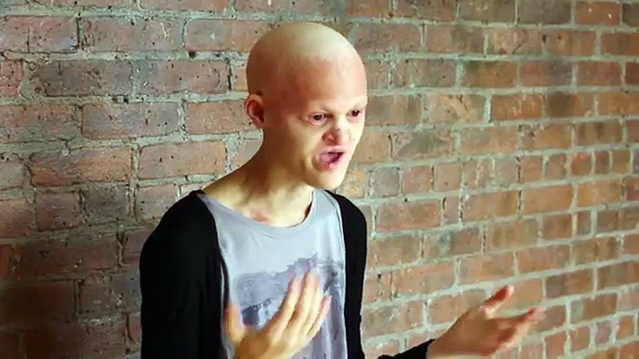 Humiliée car elle n’a pas de cheveux ni de dents, cette jeune femme a pris sa revanche… découvrez ce qu’elle est devenue