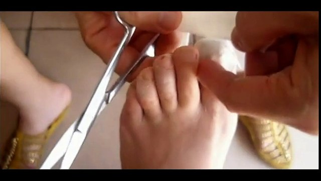 Professional Foot Care (55) Applying medicine and Bandaging infected toes