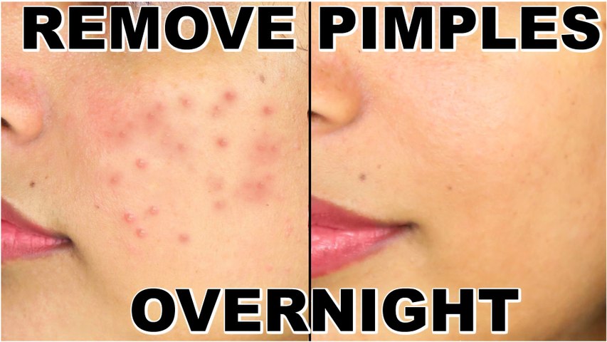How To Remove Pimples Overnight _ Acne Treatment