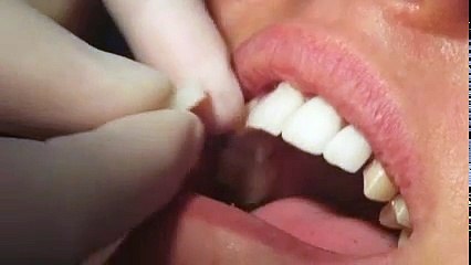 Veneers - Dentistry at Park Place in Montgomery, AL