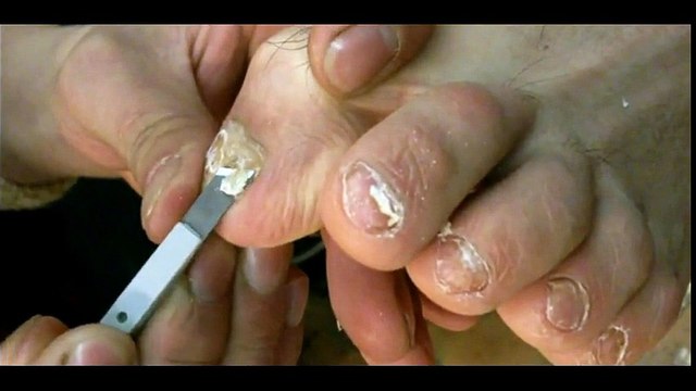 Professional Foot Care (61) Relaxing Nail Pedicure and Treatment of Nail Fungus