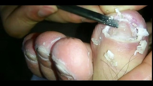 Professional Foot Care (62) Relaxing Nail Pedicure and Treatment of Nail Fungus