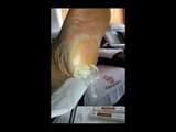 Professional Foot Care (70) Removal of Dirt and Hard Skin