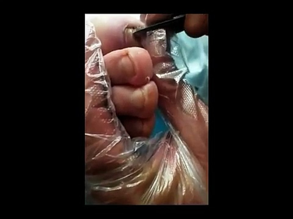 Professional Foot Care (76) Relaxing Treatment of Foot Diseases and Nail Fungus