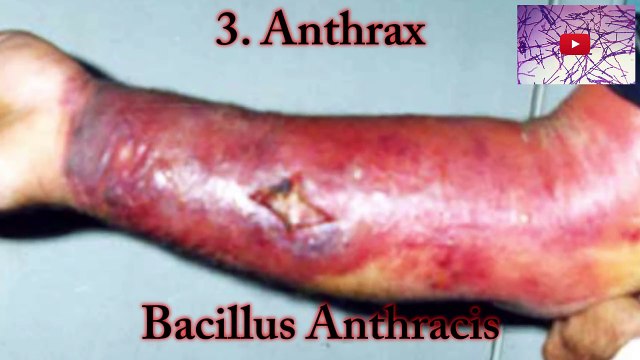 Top 5 Most Dangerous Germs and Viruses