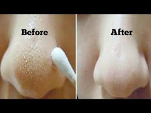 Nose Full Of Blackheads Blackheads Removal With Pore Strips