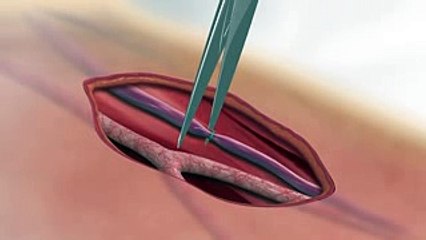 Laminate Medical Technologies - VasQ Implantation Procedure