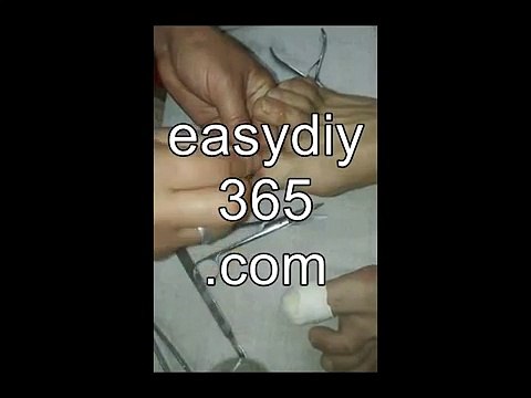 Professional Foot Care (99) Treatment of Foot Diseases and Nail Fungus