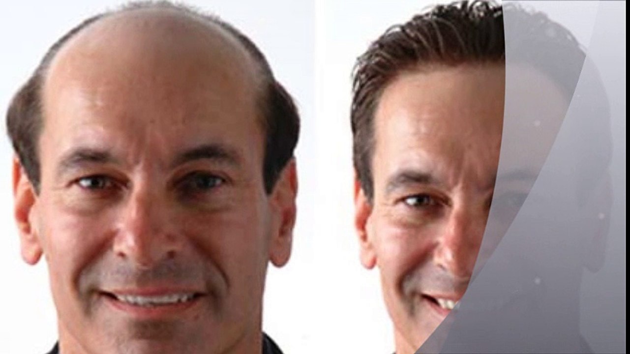 مقارنة بين زراعة الشعر بالإقتطاف و زراعة الشعر بالشريحة