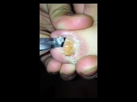 Professional Foot Care (113) Treatment of Foot Diseases and Nail Fungus