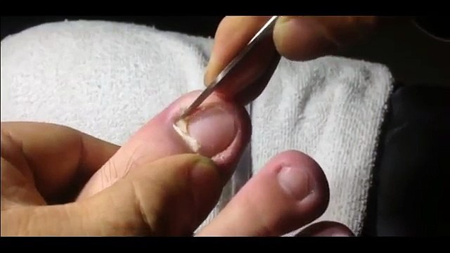 Professional Foot Care (118) Treatment of Foot Diseases and Nail Fungus