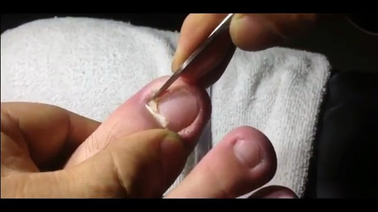 Professional Foot Care (118) Treatment of Foot Diseases and Nail Fungus