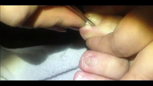 Professional Foot Care (119) Treatment of Foot Diseases and Nail Fungus