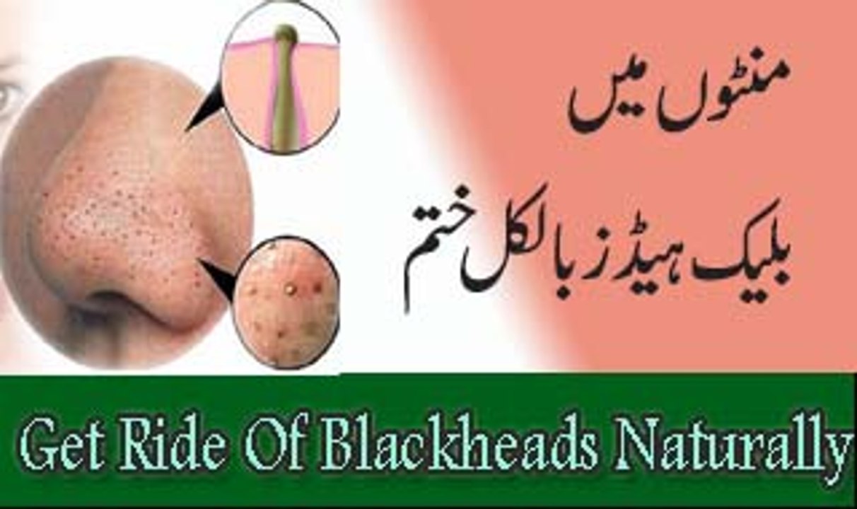 Natuarl Remedy To Remove Blackheads And Whiteheads