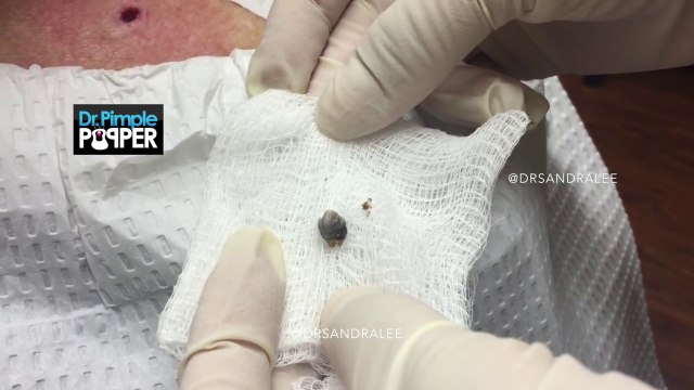 Fata a văzut un PUNCT negru pe spatele mamei sale, dar când a început să-l scoată... Du-te la doctor dacă ai așa ceva!